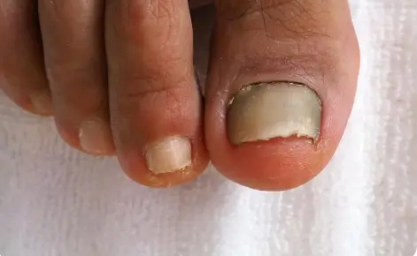 Types of Nail Infections and Their Causes