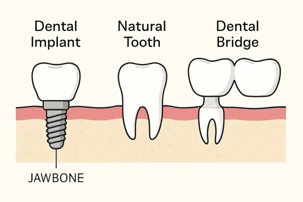Weighing Your Choices: An In-Depth Look at Why Dental Implants Might Be the Perfect Fit for Your Long-Term Oral Health