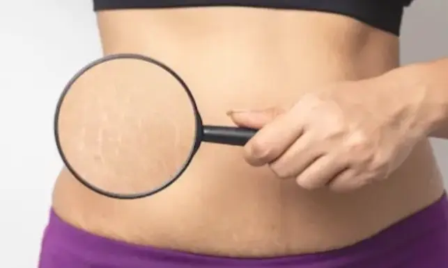 Say Goodbye to Scars How a Belly Mask for Stretch Marks Can Help