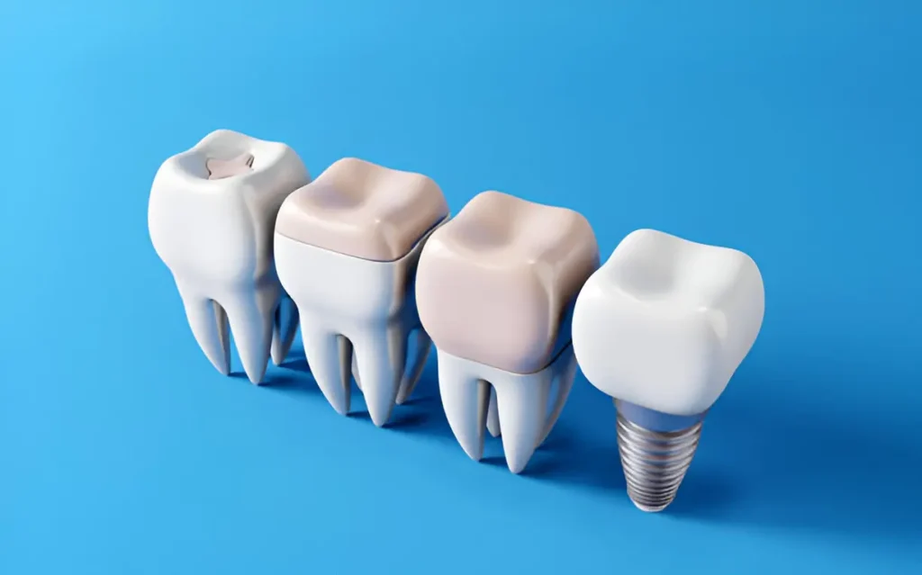 Top Reasons People Choose a Full Set of Dental Implants
