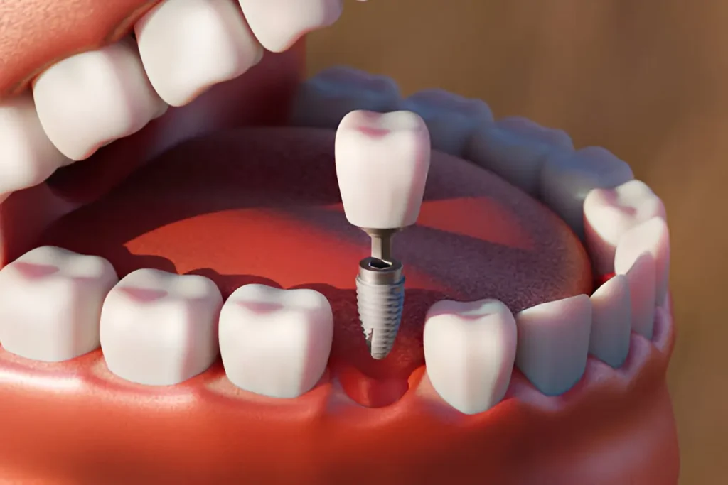 Root Canal Recovery: What to Expect and How to Heal Faster