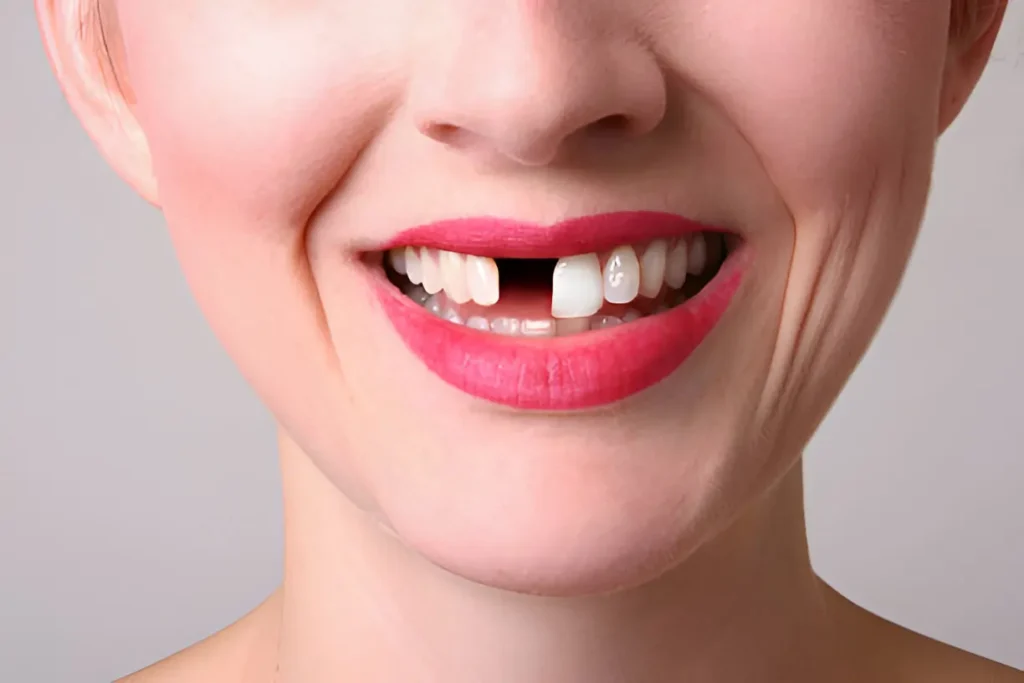The True Cost of Missing Teeth: Why Replacing Them Matters
